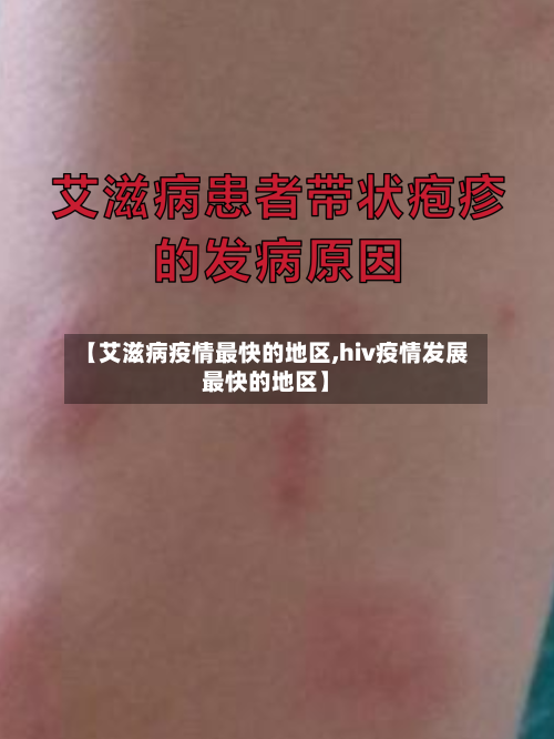 【艾滋病疫情最快的地区,hiv疫情发展最快的地区】-第2张图片